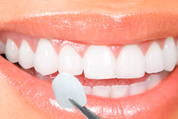 Lente de Contato dental